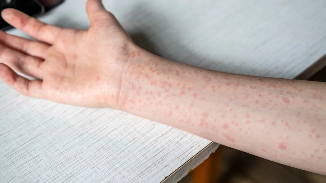 Measles symptoms on skin 