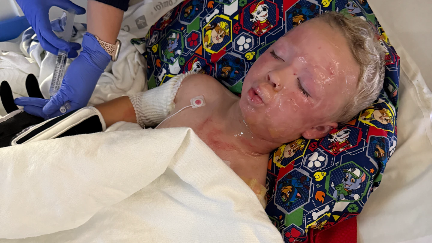 Child Burn Victim